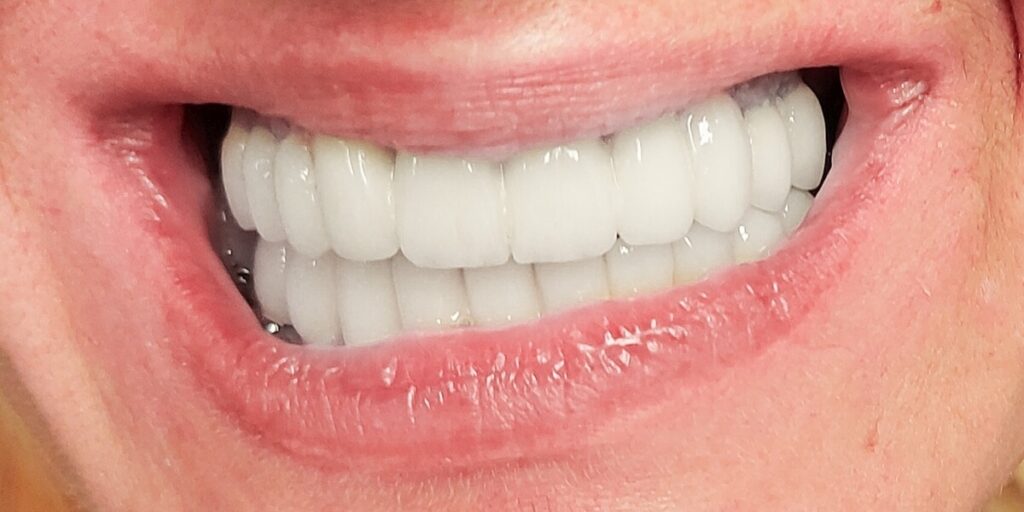 All on 4 rad pre i posle - Dental Smile Žarkovo