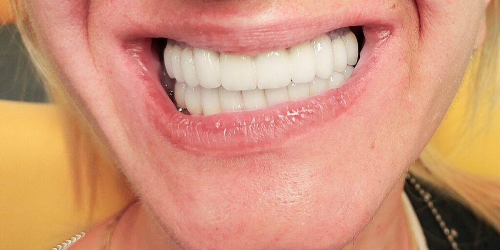 All on 4 rad pre i posle - Dental Smile Žarkovo