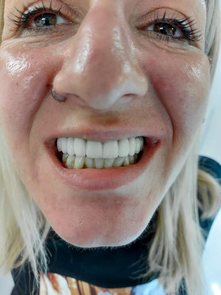 All on 4 rad pre i posle - Dental Smile Žarkovo