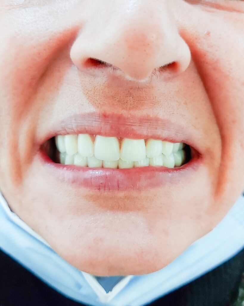 All on 4 rad pre i posle - Dental Smile Žarkovo