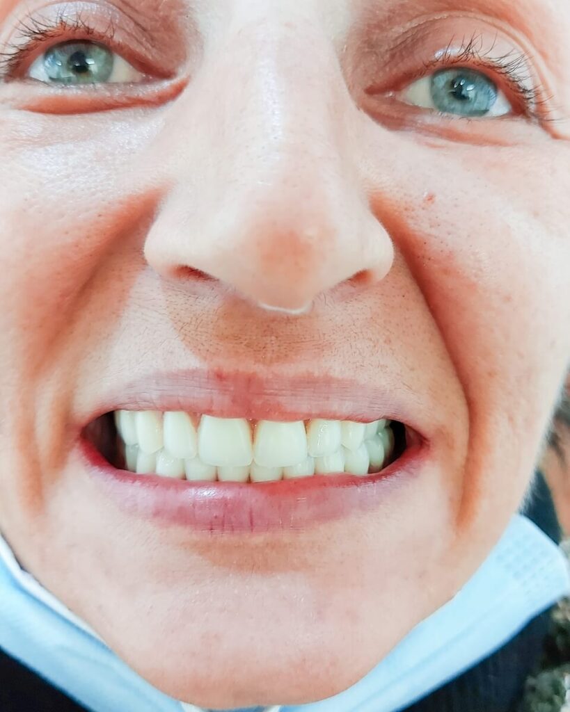 All on 4 rad pre i posle - Dental Smile Žarkovo