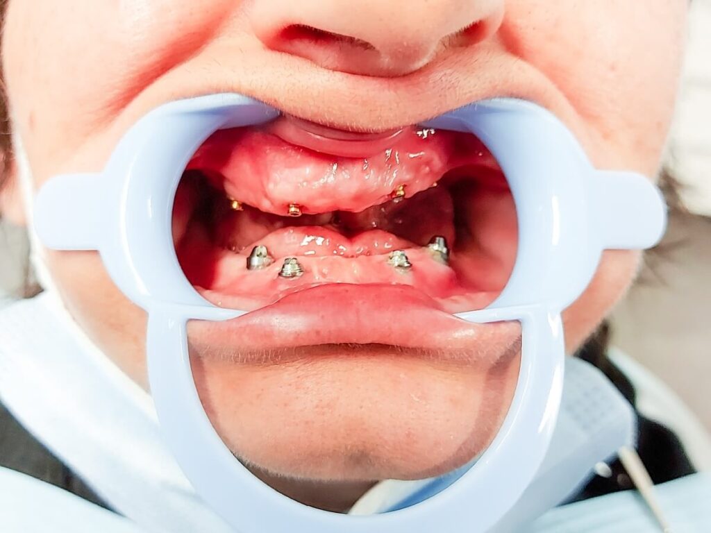 All on 4 rad pre i posle - Dental Smile Žarkovo